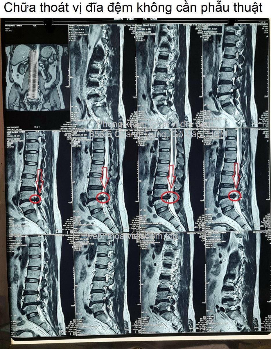 Chữa thoát vị đĩa đệm không cần phẫu thuật